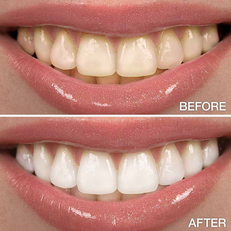 a before and after depiction of teeth with the usage of teeth whitening products